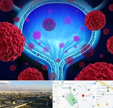 دکتر سرطان مثانه در هنگام 