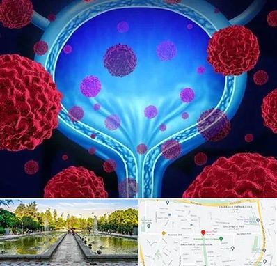 دکتر سرطان مثانه در سرسبز 