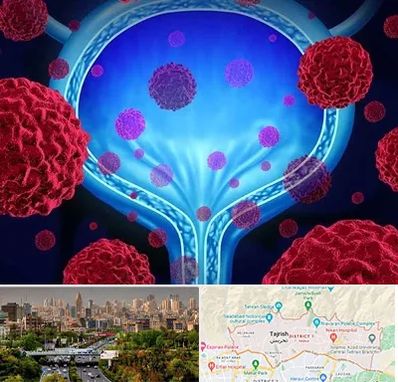 دکتر سرطان مثانه در منطقه 1 تهران 