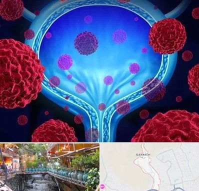 دکتر سرطان مثانه در درکه