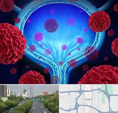 دکتر سرطان مثانه در توانیر