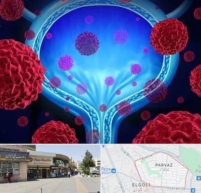 دکتر سرطان مثانه در پرواز تبریز