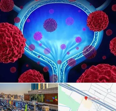 دکتر سرطان مثانه در لاله پارک تبریز