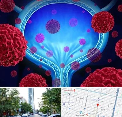 دکتر سرطان مثانه در امامت مشهد 