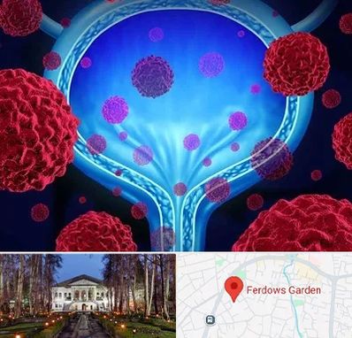 دکتر سرطان مثانه در باغ فردوس