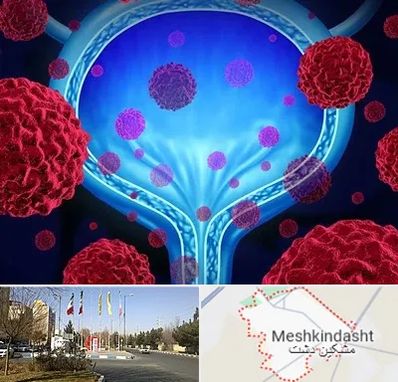 دکتر سرطان مثانه در مشکین دشت