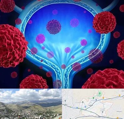 دکتر سرطان مثانه در رودهن