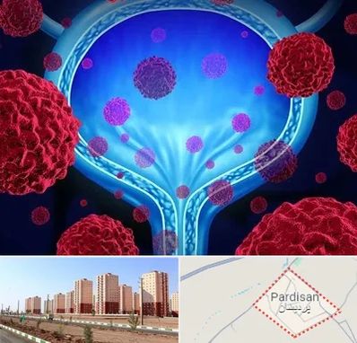 دکتر سرطان مثانه در پردیسان قم