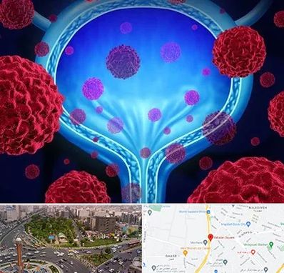 دکتر سرطان مثانه در سبلان 