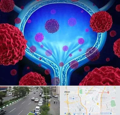 دکتر سرطان مثانه در ستارخان 