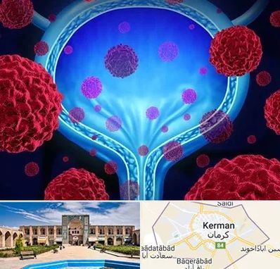 دکتر سرطان مثانه در کرمان