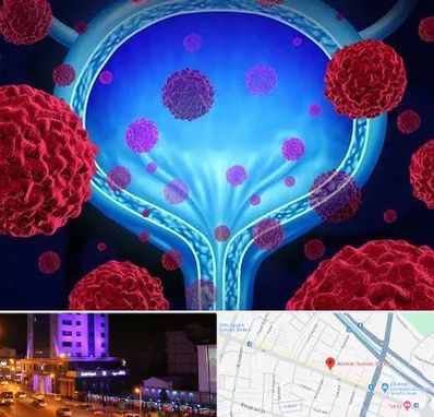 دکتر سرطان مثانه در آبرسان تبریز