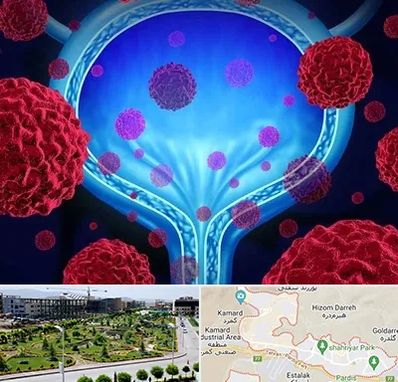 دکتر سرطان مثانه در پردیس