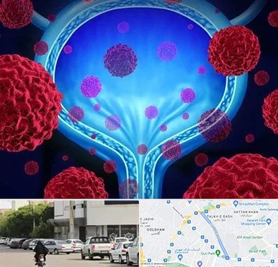 دکتر سرطان مثانه در قدوسی شرقی شیراز 