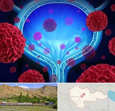 دکتر سرطان مثانه در خاش