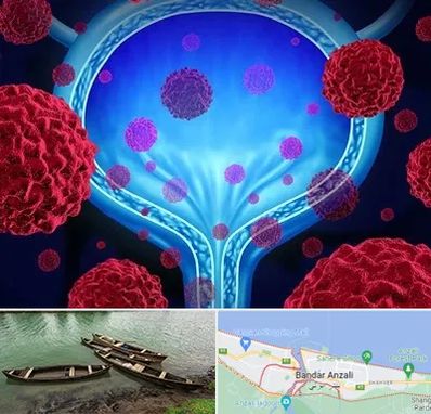 دکتر سرطان مثانه در بندر انزلی