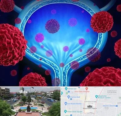 دکتر سرطان مثانه در بهارستان 