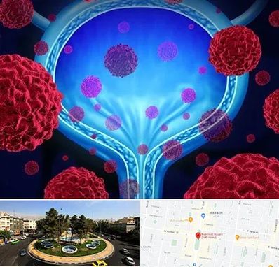 دکتر سرطان مثانه در هفت حوض 