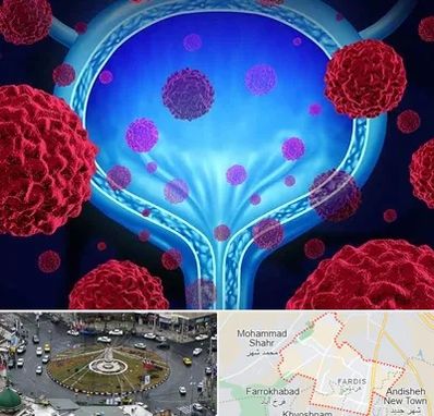 دکتر سرطان مثانه در فردیس کرج 