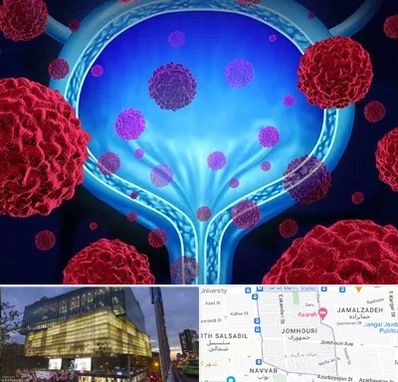 دکتر سرطان مثانه در جمهوری