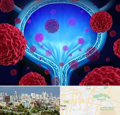 دکتر سرطان مثانه در شرق تهران 