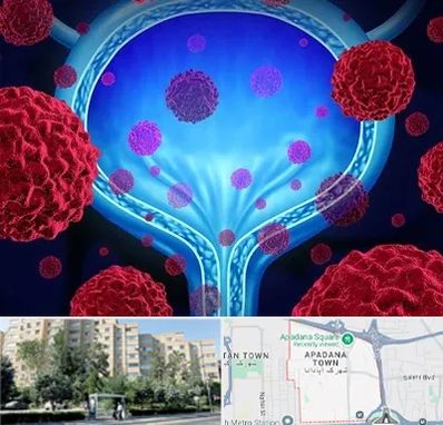 دکتر سرطان مثانه در آپادانا