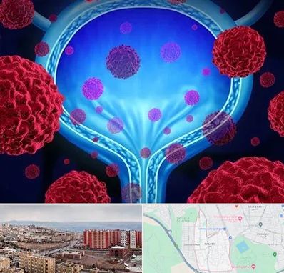 دکتر سرطان مثانه در سهند تبریز