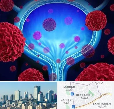 دکتر سرطان مثانه در قیطریه 