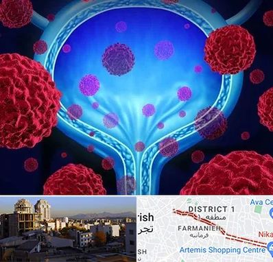 دکتر سرطان مثانه در فرمانیه 