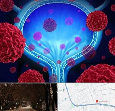 دکتر سرطان مثانه در ابوریحان تبریز