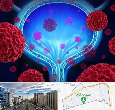 دکتر سرطان مثانه در سعادت آباد 