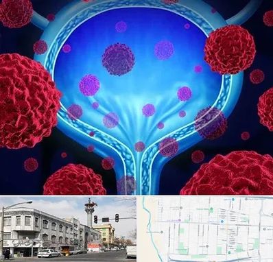 دکتر سرطان مثانه در 17شهریور