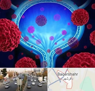 دکتر سرطان مثانه در باقرشهر