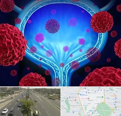 دکتر سرطان مثانه در منطقه 17 تهران 