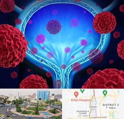 دکتر سرطان مثانه در ونک 