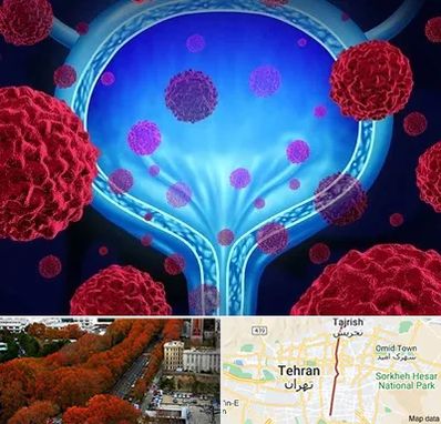 دکتر سرطان مثانه در ولیعصر 