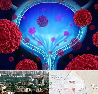 دکتر سرطان مثانه در عظیمیه کرج 