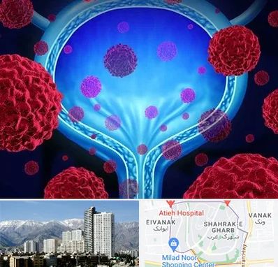 دکتر سرطان مثانه در شهرک غرب 