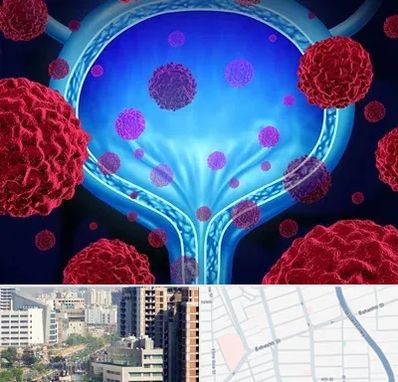 دکتر سرطان مثانه در خیابان بهشتی