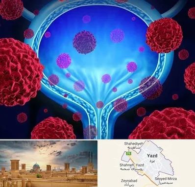 دکتر سرطان مثانه در یزد