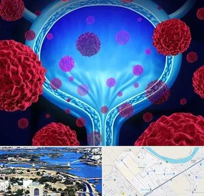 دکتر سرطان مثانه در کوروش اهواز 