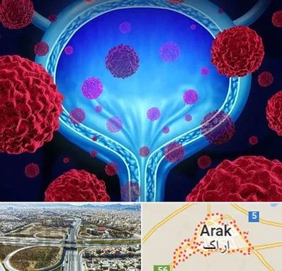 دکتر سرطان مثانه در اراک