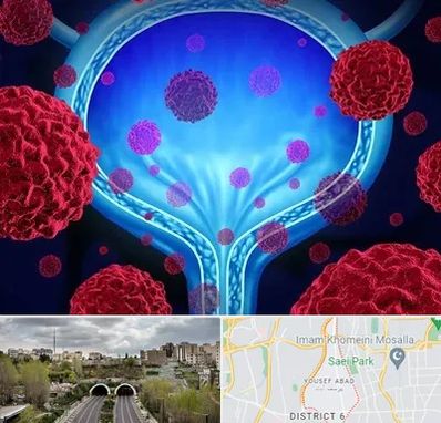 دکتر سرطان مثانه در یوسف آباد 