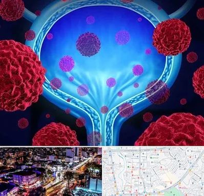 دکتر سرطان مثانه در منظریه رشت 