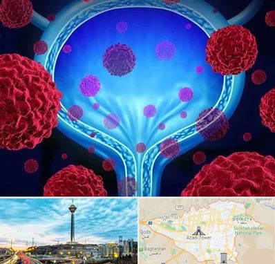 دکتر سرطان مثانه در تهران