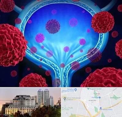 دکتر سرطان مثانه در فرشته 