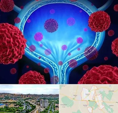 دکتر سرطان مثانه در شهریار