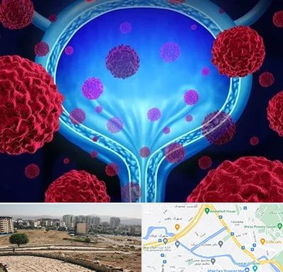 دکتر سرطان مثانه در کوی وحدت شیراز 