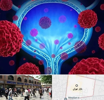 دکتر سرطان مثانه در بازار تهران