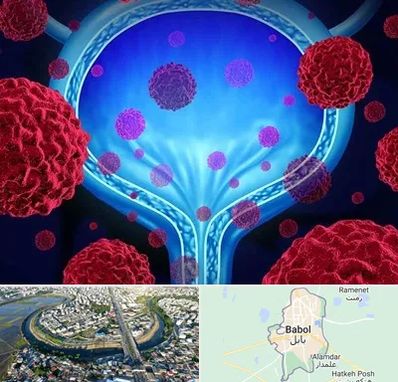 دکتر سرطان مثانه در بابل